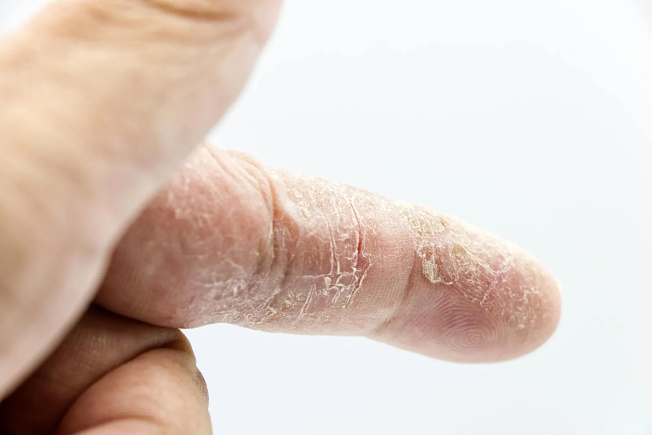 Psoriasis - an autoimmune disease that goes deep under the skin